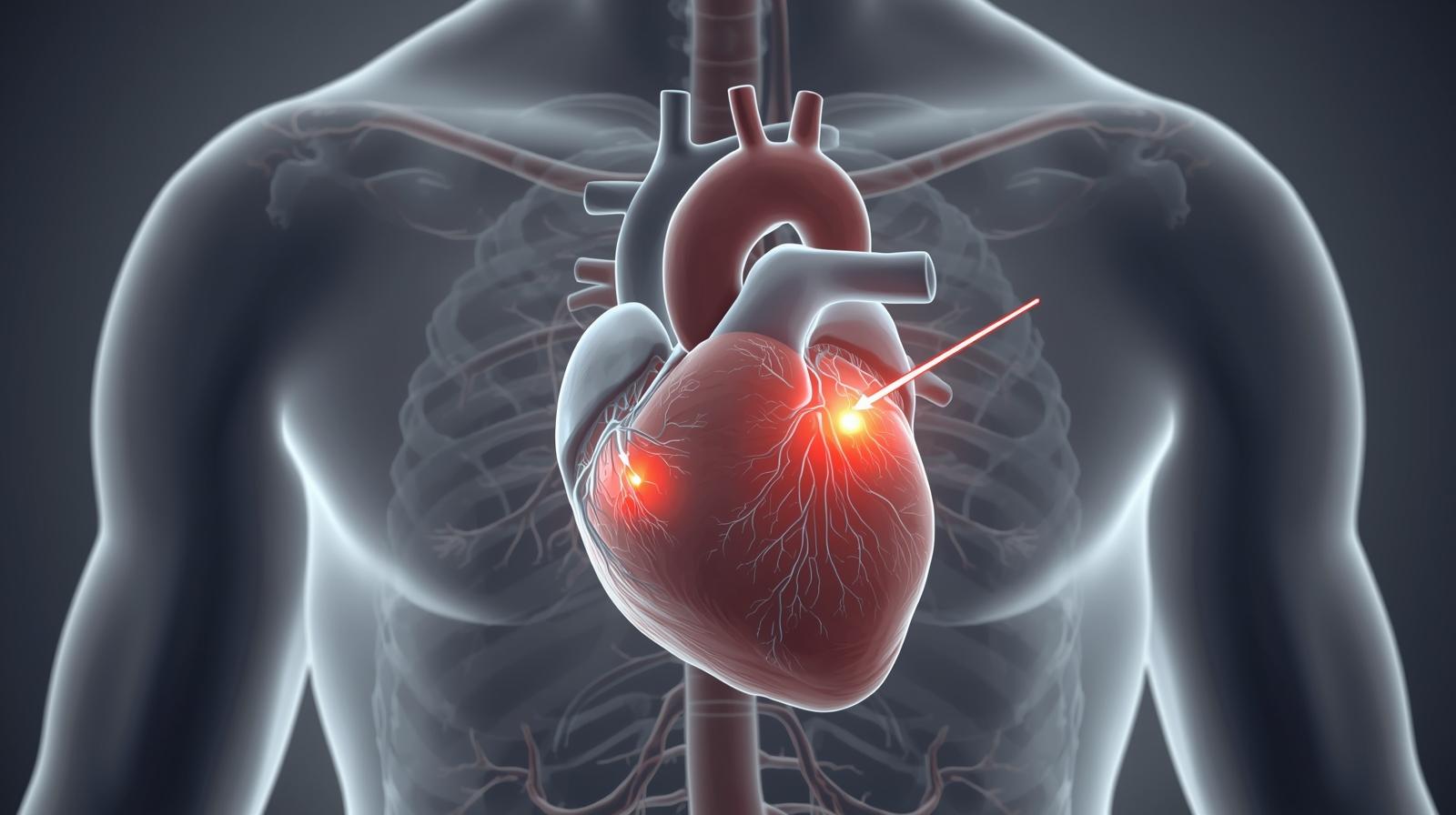 Angina