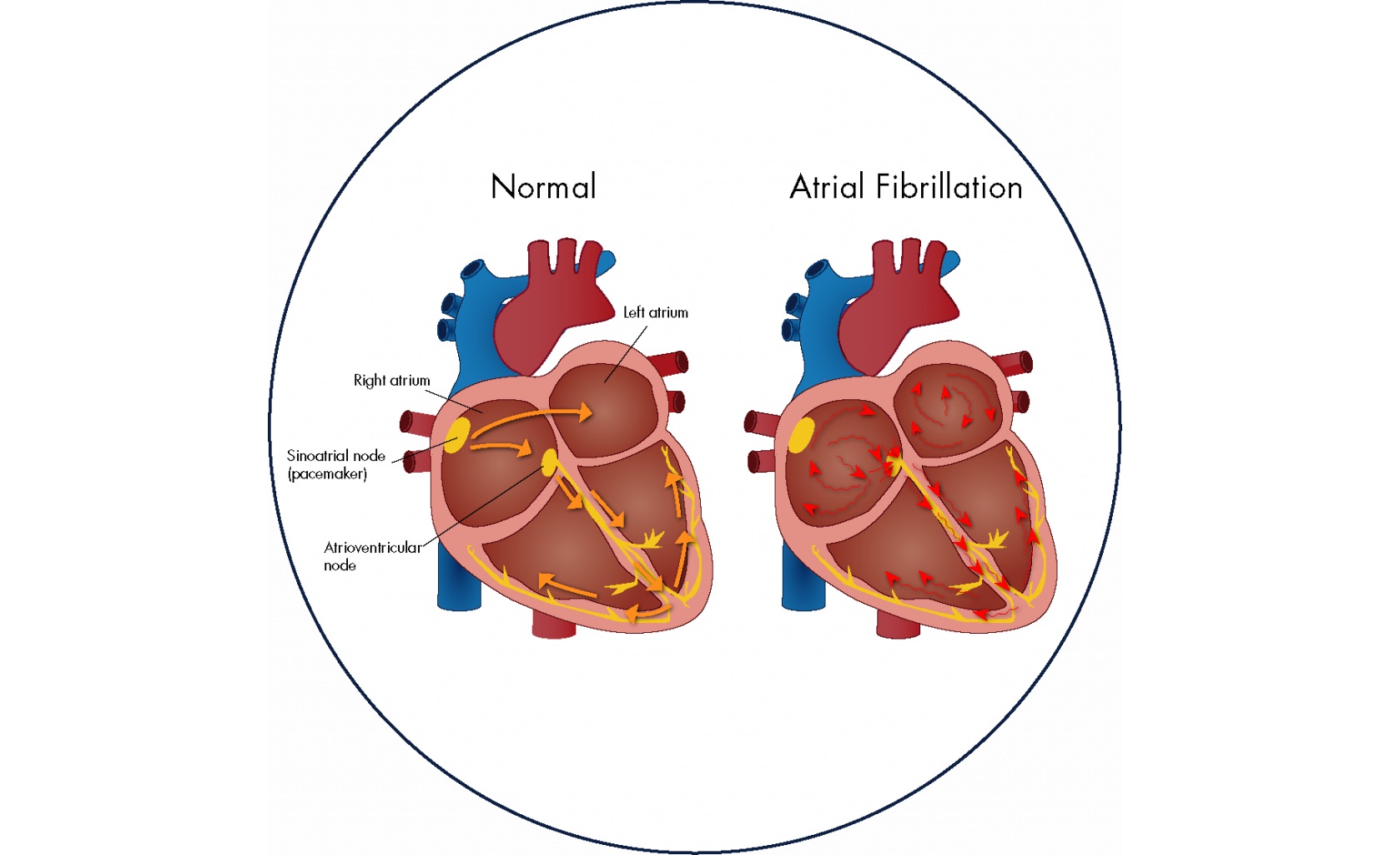 Atrial Fibrillation