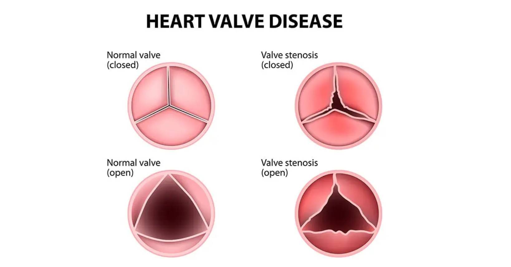 Valve Disease